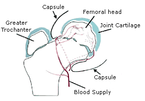 Legg-Calve-Perthes_Disease (2).gif